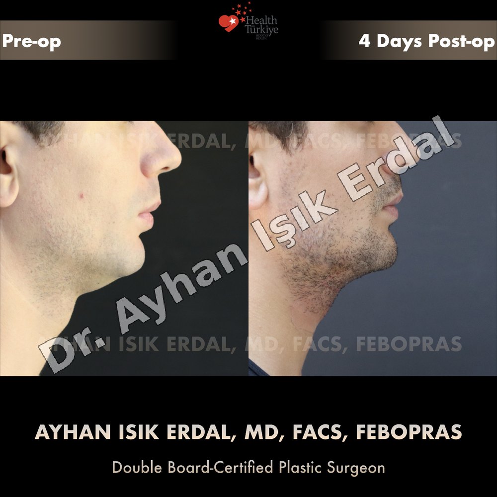 Chin implant before and after — profile view, 4 days post-op, patient of Dr. Ayhan Işık Erdal, Istanbul