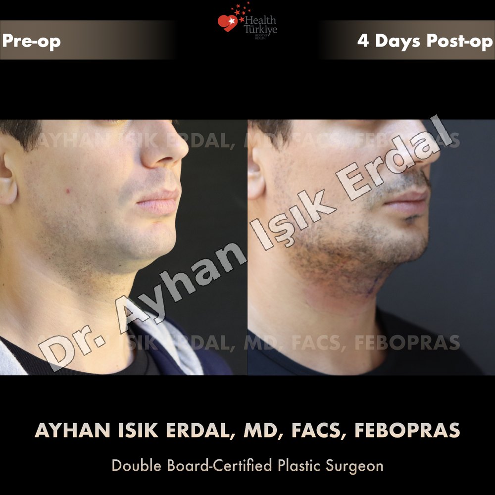 Chin implant before and after — three-quarter view, 4 days post-op, patient of Dr. Ayhan Işık Erdal, Istanbul